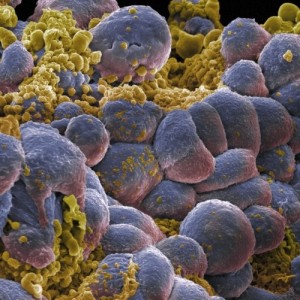 B0006422 Breast cancer cells