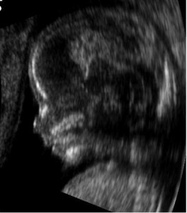 Embryo_at_14_weeks_profile
