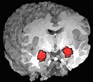PD  Amygdala_position