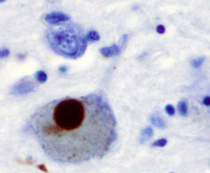 Marvin 101 wik Lewy_Body_alphaSynuclein