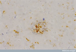 B0002158 Alzheimer's brain showing plaque & microglia