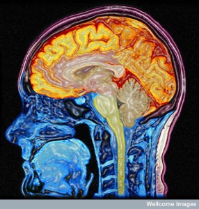 B0005622 Enhanced MRI scan of the head