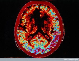 N0013781 Cerebral infarct