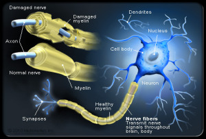 multiple-sclerosis-s4-illustration-of-nerve-fibers-and-myelin-attack-in-ms
