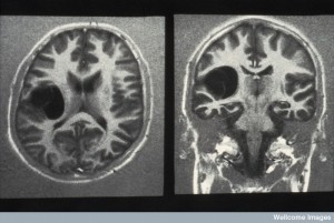 N0009762 MRI scan; brain cancer (glioma)
