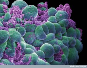 B0006421 Breast cancer cells