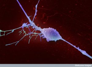 B0006918 Retinal ganglion cell Credit: Annie Cavanagh. Wellcome Images images@wellcome.ac.uk http://wellcomeimages.org An isolated retinal ganglion cell. This is a type of neuron typically located near the inner surface of the retina of the eye that receives visual information from photoreceptors via two intermediate neuron types. Retinal ganglion cells collectively transmit visual information from the retina to several regions in the thalamus, hypothalamus, and midbrain. They vary significantly in terms of their size, connections, and responses to visual stimulation but they all share the defining property of having a long axon that extends into the brain. These axons form the optic nerve, optic chiasm, and optic tract. Scanning electron micrograph 2008 Published:  -  Copyrighted work available under Creative Commons by-nc-nd 4.0, see http://wellcomeimages.org/indexplus/page/Prices.html