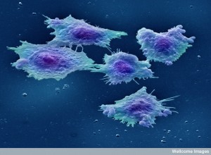 B0006255 Human colon cancer cells