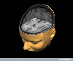 B0003572 Cut-away MRI of brain