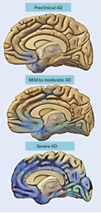 PD ALz brain progression