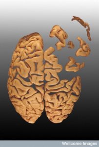 B0003253 Brain falling apart - artwork Credit: Heidi Cartwright. Wellcome Images images@wellcome.ac.uk http://wellcomeimages.org Photograph of the superior aspect of a human brain manipulated to represent the brain falling to pieces. Photograph - digitally modified 2000 Published: - Copyrighted work available under Creative Commons by-nc-nd 4.0, see http://wellcomeimages.org/indexplus/page/Prices.html