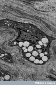 B0001797 Corneal stromal cell with lipid vesicles
