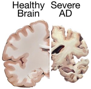 PD Alzh brain