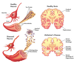 medical illustration of the symptoms of Alzheimer's disease