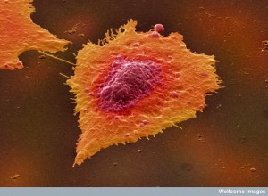B0006256 Human colon cancer cells